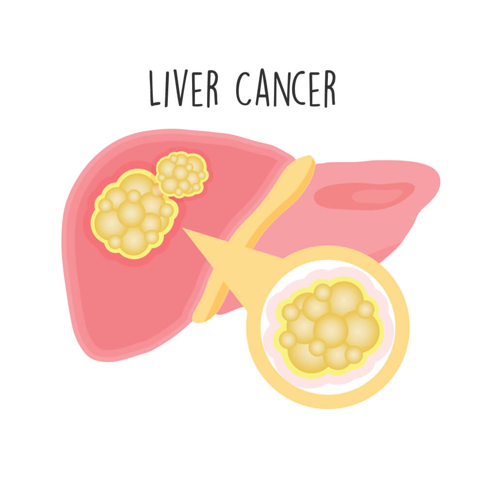 Stages of Liver Cancer & Financial Assistance for it Impactguru